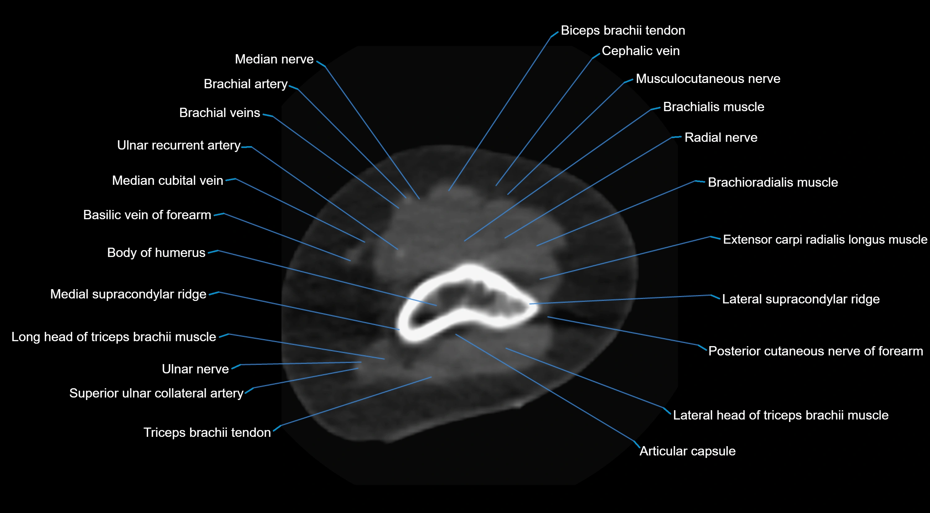 CT elbow axial  cross sectional anatomy labelled  radiology image -00009.webp